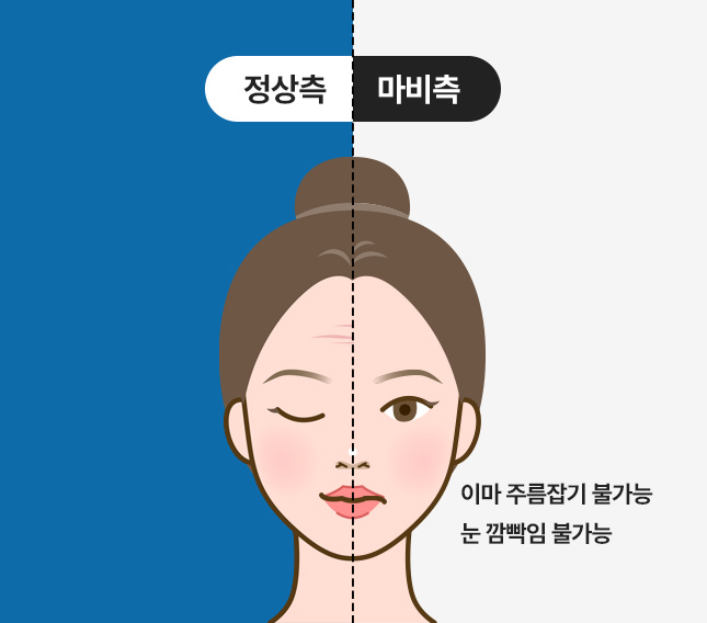 정상측 / 마비측 - 이마 주름잡기 불가능, 눈깜박임 불가능